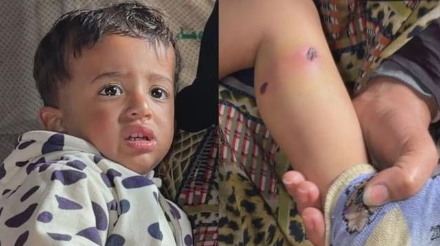 Toddler Tortured in Gaza to Coerce;സിഗരറ്റ് കുറ്റികൊണ്ട് ഒന്നരവയസ്സുകാരന്റെ ദേഹം പൊള്ളിച്ചു... കാലില് ആണി കുത്തിക്കയറ്റി' കണ്ണില്ലാ ക്രൂരത 1 280351
